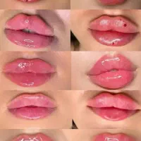 ژل لب و بوتاکس