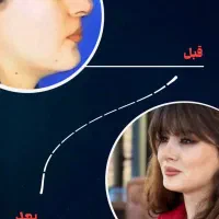 مشاوره تخصصی جراحی زیبایی بینی،نتایج طبیعی