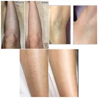 تخفیف ویژه /لیزر/فیشال درمان قطعی جوش منافذ اسکار