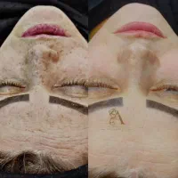 پلاسما تراپی با دستگاه شاتی