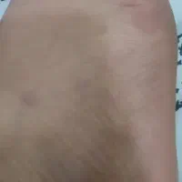 پدیکورتخصصی پارافین تراپی ،تیرگی قوزک ،لایه برداری