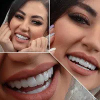 جشنواره کامپوزیت لیرینگ لمینیت عصب روکش ترمیم IPS