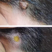 سوراخ کردن گوش ،خالبرداری و برداشتن زگیل در مطب