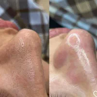 پاکسازی پوست تخفیف بهاره