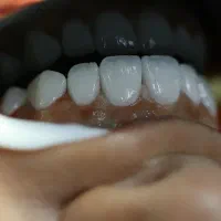 ایمپلنت اقساطی عصبکشی روکش لمینت دندانپزشکی قسطی