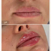 هدیه ویژه برای لیزر اولی ها فقط تا پایان این ماه