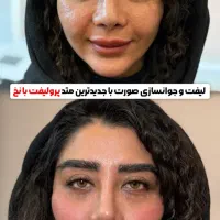 مدل رایگان لیفت با نخ ،ساکشن غبغب،بلفارو