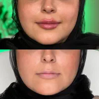 کانتورینگ کامل صورت با ۴ cc فیلر فقط ۲۴ت با بوتاکس