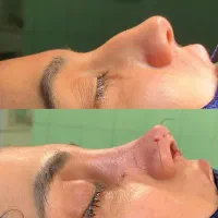 عمل بینی با هزینه باورنکردنی ویژه دی ماه