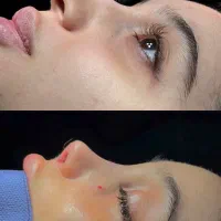 عمل بینی با دستگاه و بخیه لیزری