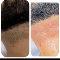 تخفیف ویژه لیزر فول بادی