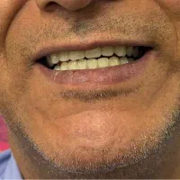 دندان مصنوعی دندانسازی اقساط
