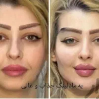 آفر ویژه نیمه بها ۳روزه بوتاکس فیلر لب روسی