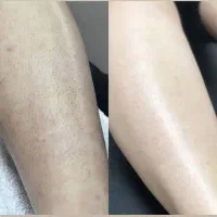لیزر مو با دستگاه شاتی