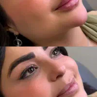 زیبایی ژل بوتاکس