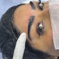 جشنواره جراحی پلک ، تزریق چربی، لیفت صورت