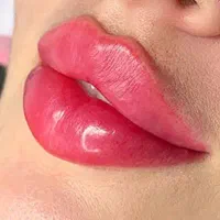 فیلر لب/گونه/چانه/بوتاکس