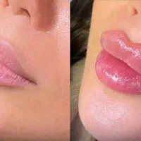 فیلر و بوتاکس با نتایج طبیعی و ماندگار