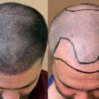 تنهامرکز مجاز کاشت مو و ابرو کوهدشت با مجوز بهداشت