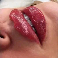 فیلر بوتاکس مزوتراپی فیلربادی و ....