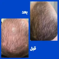 کچلی زیبا نیست
