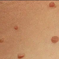 تو هم استرس داری و رنج میبری از داشتن اچ پی وی