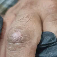درمان ناخن فرو رفته در گوشت با ۵۰ درصد تخفیف