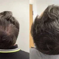 پرپشتی موهات در ۳۰ روز