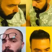 کاشت مو