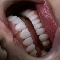کامپوزیت دندان و ترمیم