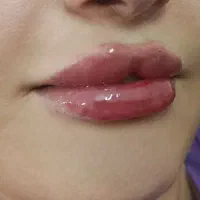 تزریق فیلر و بوتاکس