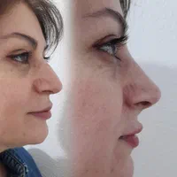 اصلاح قوز و افتادگی بینی با تزریق فیلر در مطب پزشک