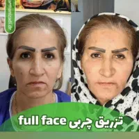 تزریق انواع بوتاکس ژل آنزیم مزو پی آرپی، نخ لیفت