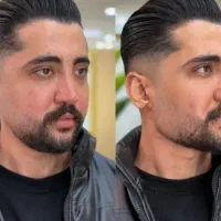 بوتاکس لیفت صورت فیلرزاویه لب پی آر پی مزوتراپی
