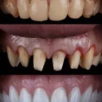 خدمات تخصصی روکش دندان