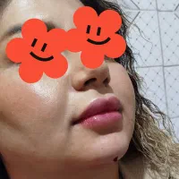 بوتاکس،انواع فیلر ومزوتراپی (وعمل های زیبایی زنان)