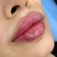آموزش و تزریق فیلر و بوتاکس