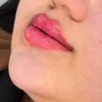 تزریق ژل بوتاکس نخ لیفت فیلر بادی یوسفی مقدم