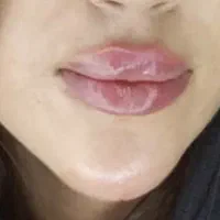 لیپوفیس ، ساکشن و تخلیه چربی غبغب