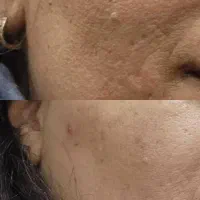 تزریق بوتاکس آقاوخانم،رفع کک،مک دوجلسه کلینیک سهند