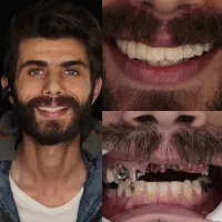 عصب‌کشی و ترمیم تخصصی بدون درد