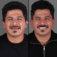ایمپلنت/اقساطی‌ویژه‌خردادماه/ظرفیت‌محدود