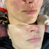 پاکسازی صورت با دستگاه