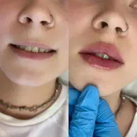 تخفیف عیدانه فیلر بوتاکس چال لپ ژل پیرسینگ فیشیال