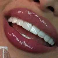 دندانپزشکی کامپوزیت عصب کشی در شهرری ۴۰٪تخفیف