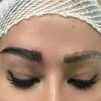 کاشت ابرو