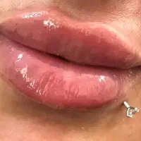 ژل لب (فیلر) و بوتاکس صورت