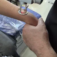 لیزر CO2 برطرف کردن اسکار (دکتر علی بابایی)