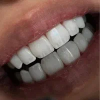 دندانپزشکی زیبایی لبه شیشه ای -ایمپلنت (کاشت دندان
