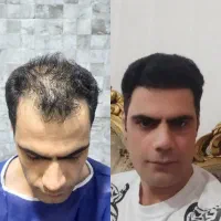 کاشت مو فول تراکم وی ای پی شیرازی